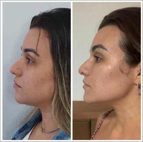 Contorno Facial