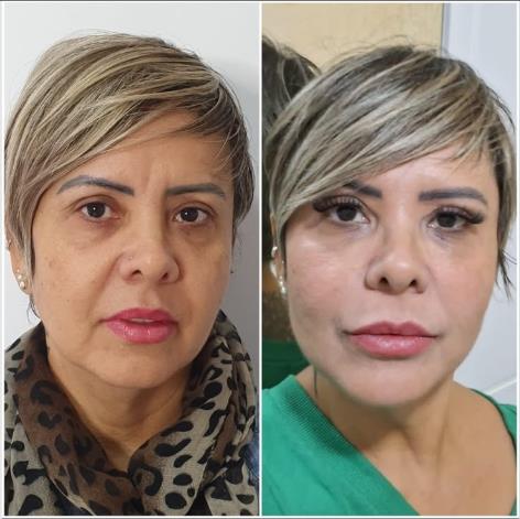 Harmonização facial full face